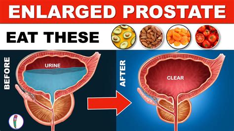 does milking prostate help enlarged prostate